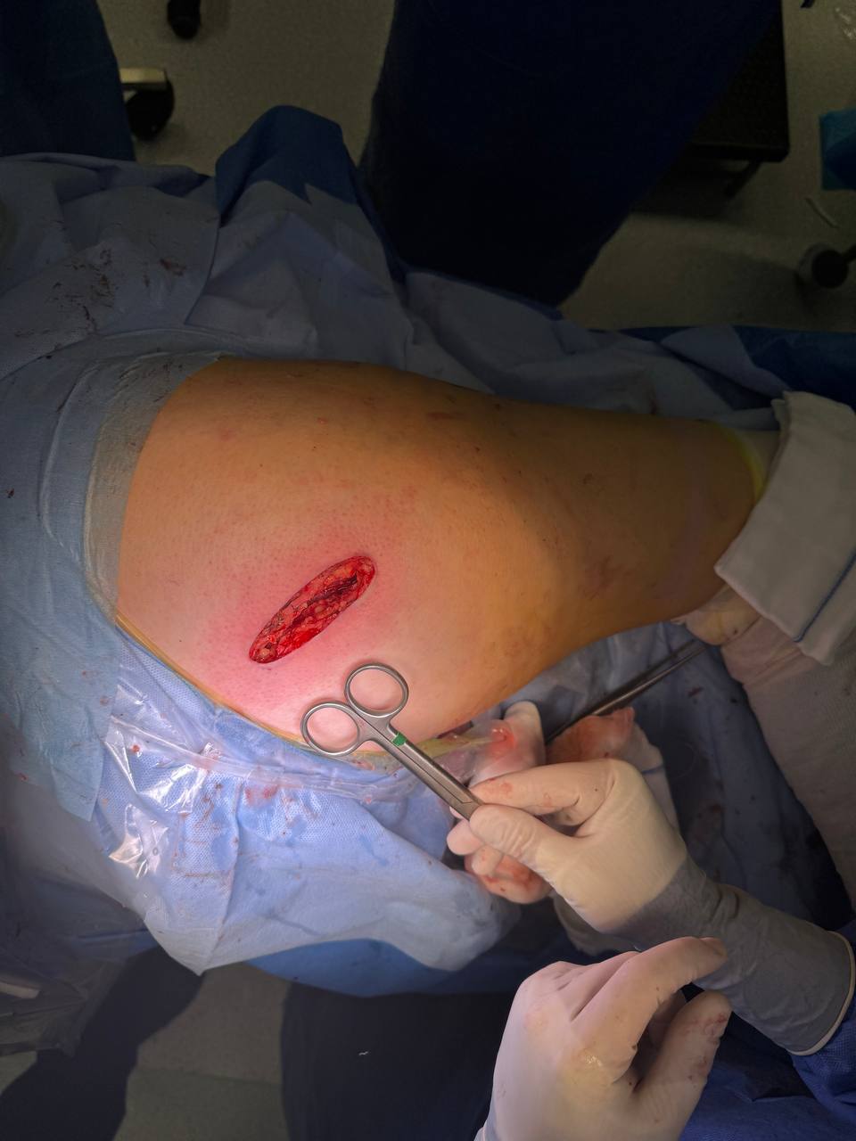 Minimally invasive hip replacement surgical approach