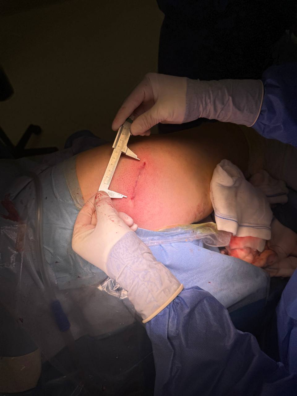 Measurement of a small incision during total hip replacement