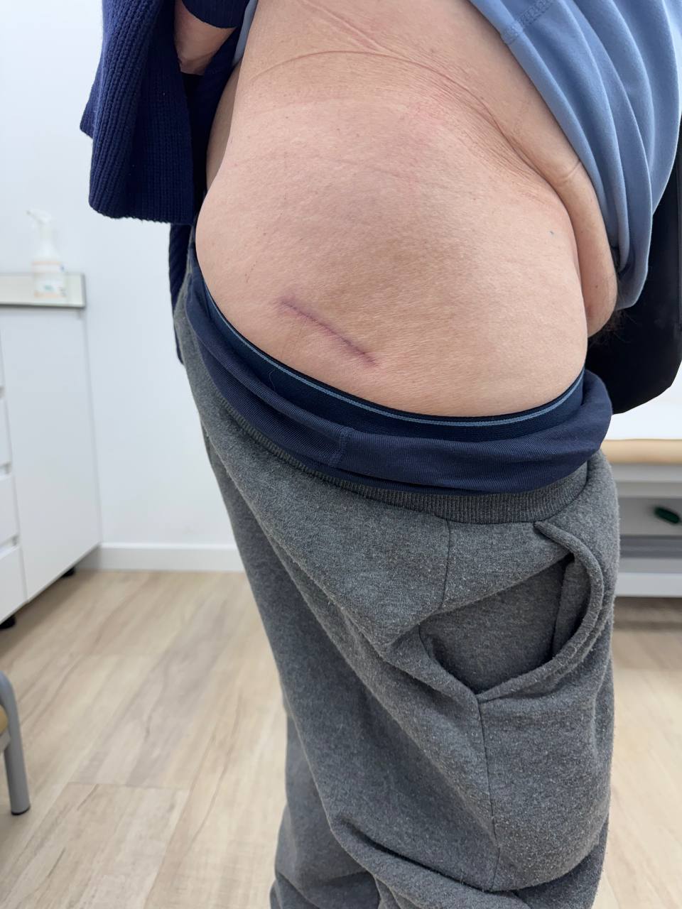 Minimally invasive total hip replacement incision by David Fernández-Fernández MD in Alicante