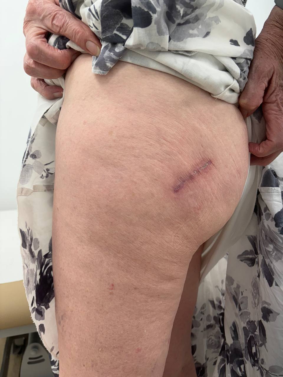 Soft-tissue respectful minimally invasive hip exposure