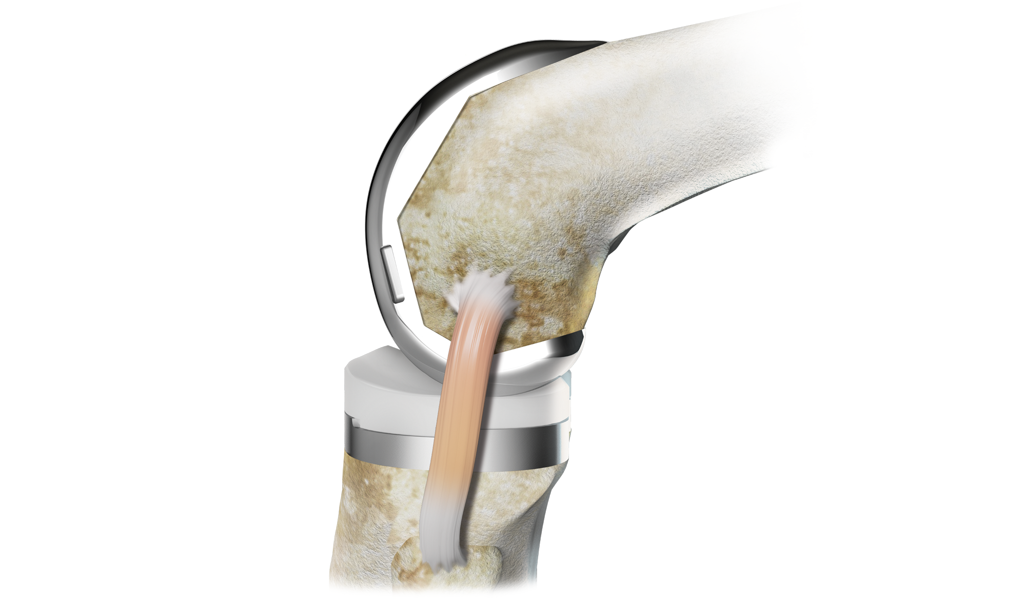 Stryker Triathlon — Primary total-knee femoral, tibial and polyethylene components.