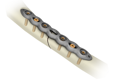 Stryker VariAx 2 Compression — Official system image showing plates and compression instrumentation for fracture fixation.